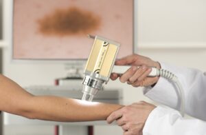 Dermomedic - Cáncer de piel: prevención y detección precoz con dermatoscopia digital