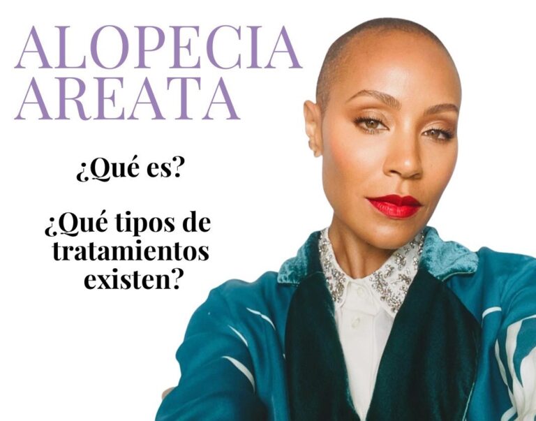 Dermomedic - Alopecia areata ¿Qué es? ¿Cuál es su tratamiento?