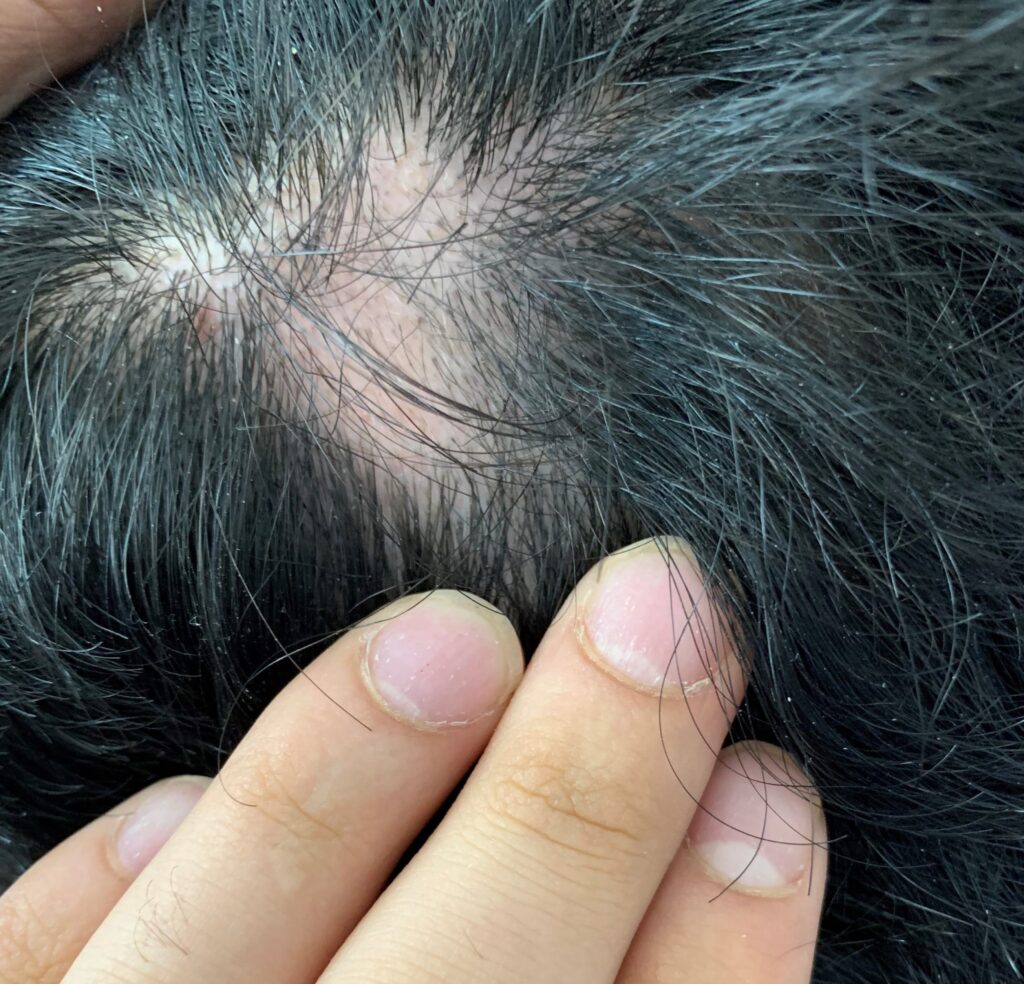 Primer Tratamiento Sistémico Para La Alopecia Areata - Clinica DermoMedic