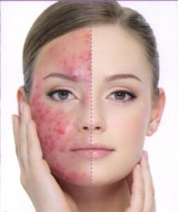 Dermomedic - Consejos para dejar atrás el acné: 3 sencillos pasos