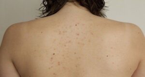 Dermomedic - Tratamiento para el acné de la espalda y torax