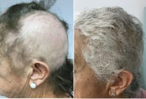 Dermomedic - Alopecia areata: Tratamiento efectivo con láser de excímeros