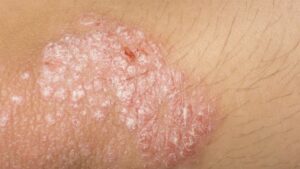 Dermomedic - Blanqueamiento de la piel de pacientes con psoriasis