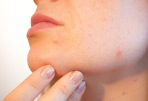 Dermomedic - ¿Cómo combatir el acné? Tenemos los tratamientos necesarios
