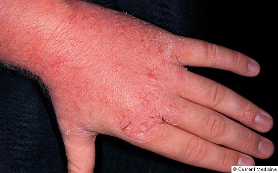 Dermomedic - Medicamento para el tratamiento de la dermatitis atópica