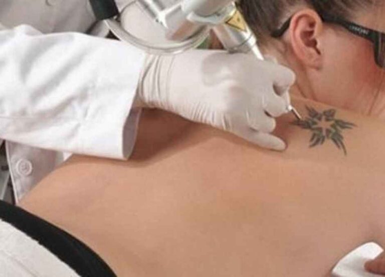 Dermomedic - ¿Cómo se pueden eliminar los tatuajes?