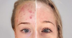 Dermomedic - El poder de la biofotónica para tratar el acné