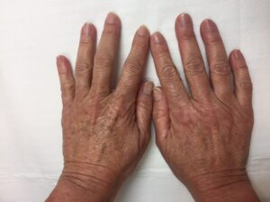 Dermomedic - Rejuvenecimiento de manos: eliminar manchas