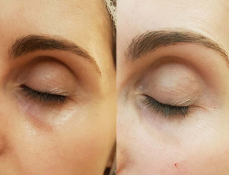 Dermomedic - Las ojeras: sus causas y tratamientos
