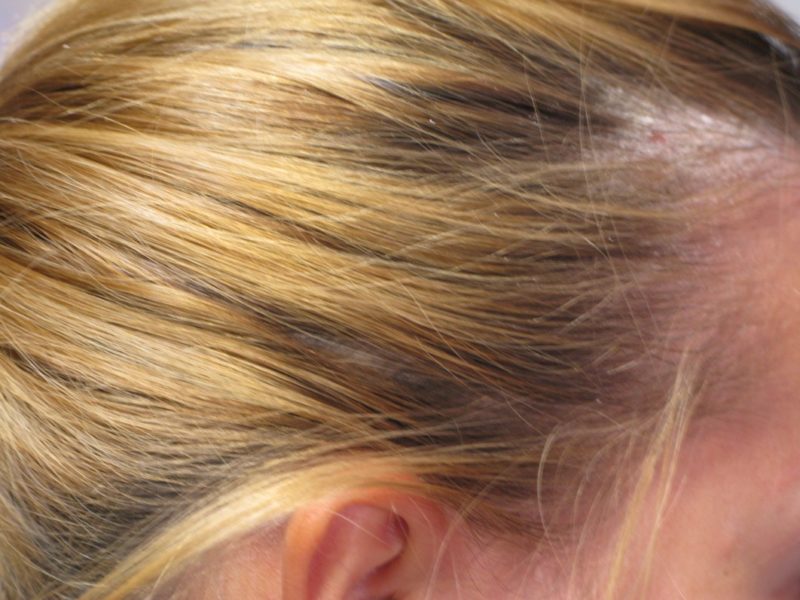 Dermomedic - Psoriasis del cuero cabelludo: tratamientos eficaces