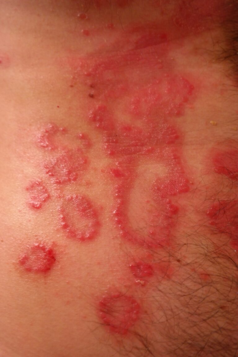 Dermomedic - Psoriasis en verano: un gran estigma