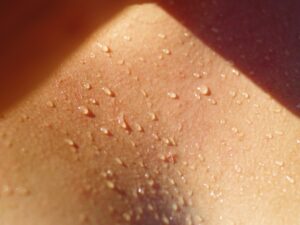 Dermomedic - ¿La sudoración excesiva tiene tratamiento?