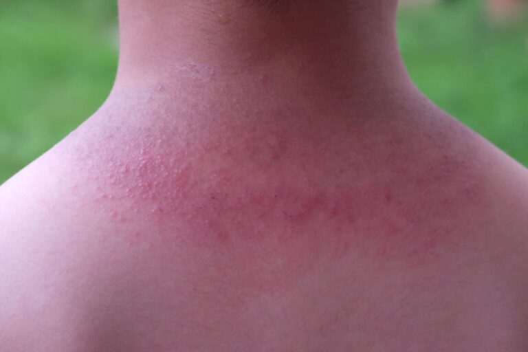 Dermomedic - Hiperhidrosis y sarpullido por calor
