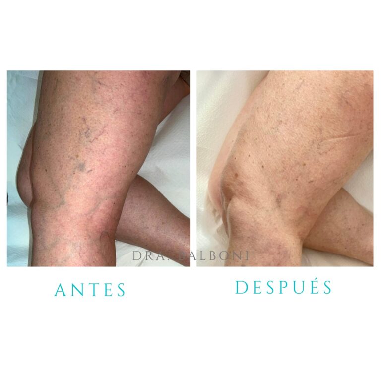 Dermomedic - ¿Tienes varices y no sabes cómo tratarlas?