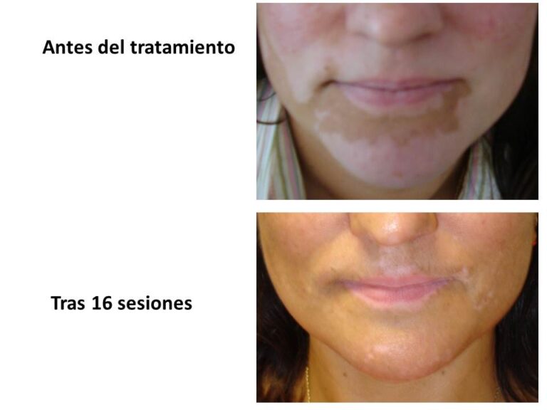 Dermomedic - Cómo identificar el vitiligio