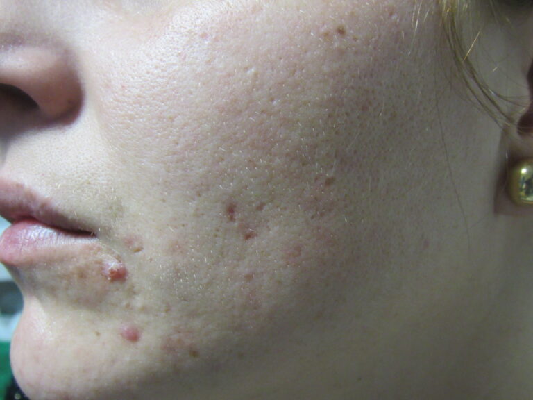 Dermomedic - Acné: nuevos tratamientos dermatológicos
