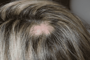 Dermomedic - Alopecia y caída del cabello: soluciones