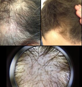 Dermomedic - Alopecia: Envejecimiento y adelgazamiento del cabello