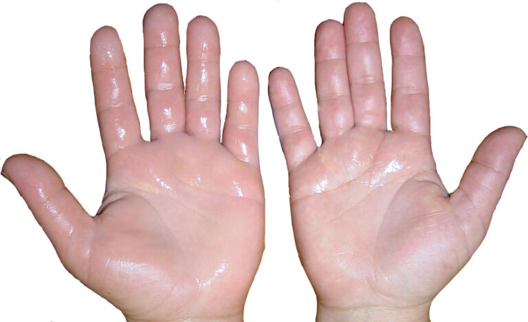 Dermomedic - Consejos sobre la hiperhidrosis
