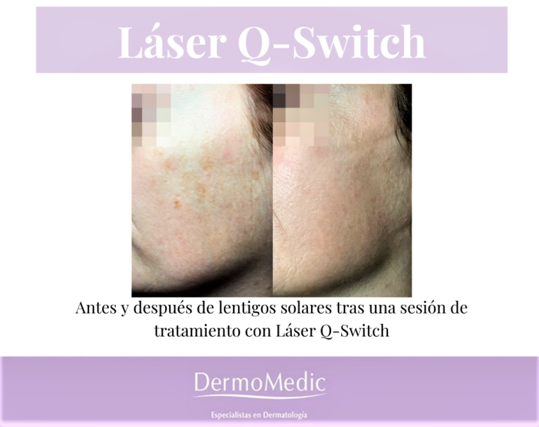 Dermomedic - ¿Quieres eliminar tus manchas de la piel?