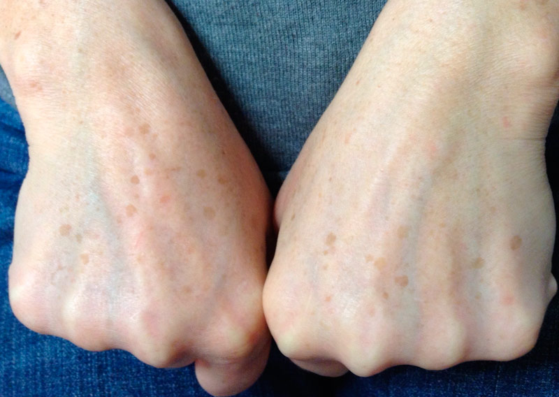 Dermomedic - ¿Se pueden eliminar las manchas en las manos?