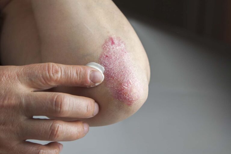 Dermomedic - El Doctor López Estebaranz responde a las preguntas más frecuentes sobre la psoriasis