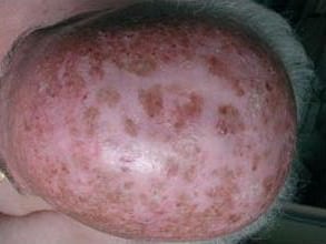 Dermomedic - Queratosis Actínicas: una patología muy frecuente premaligna. Nuevos tratamientos