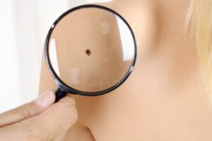 Dermomedic - 10 síntomas del cáncer de piel que no conocías