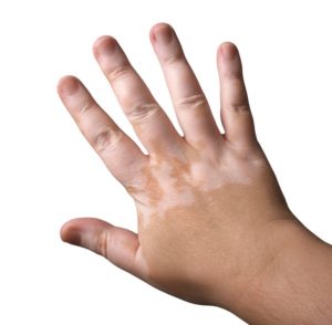 tratamiento vitiligo en madrid