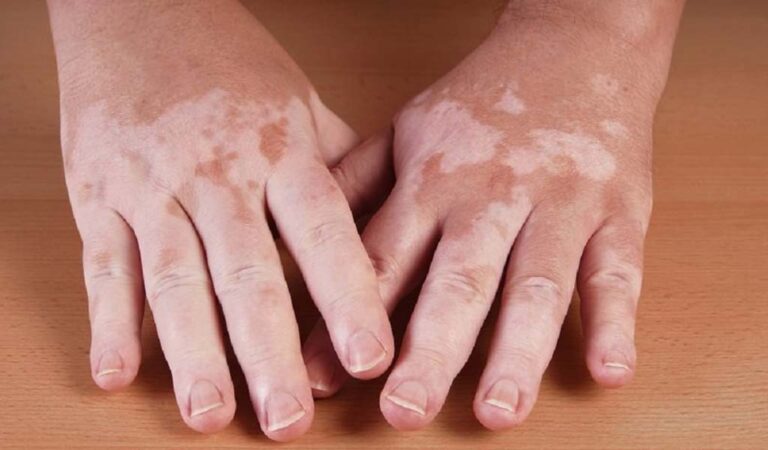 Dermomedic - Vitíligo en niños: ¿qué precauciones debo tomar en verano?