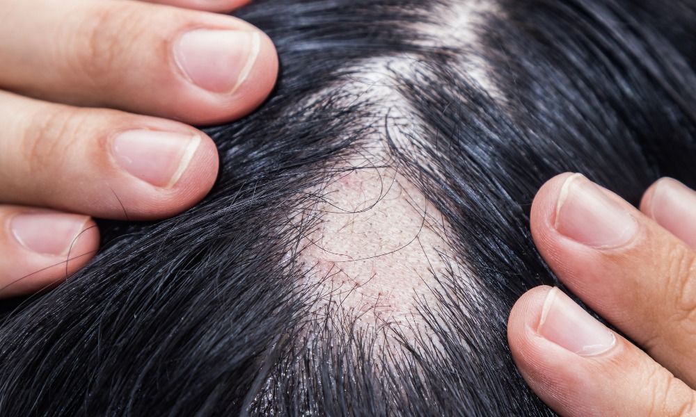 Dermomedic - La comisión Europea aprueba LITFULO™ de Pfizer para tratar la Alopecia Areata en menores