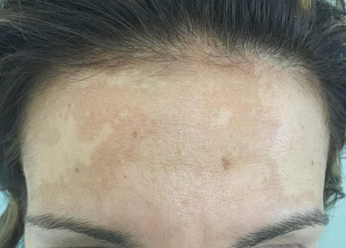 Ácido tranexámico para manchas: melasma en la frente de una paciente