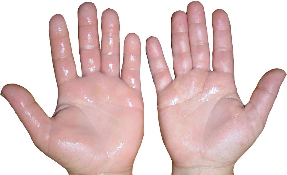Hiperhidrosis palmar: sudoración excesiva en las palmas de las manos