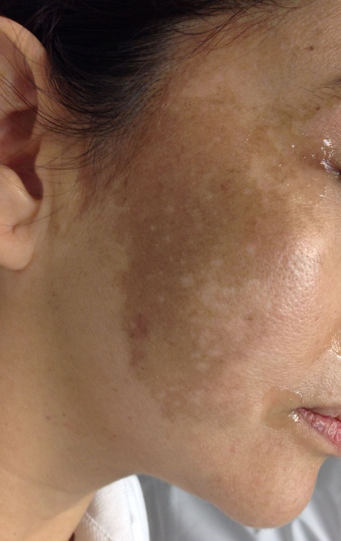 Melasma facial: manchas de hiperpigmentación en la mejilla