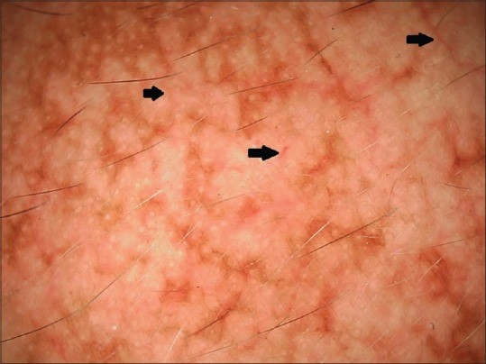 Dermatoscopia de un melasma para el diagnóstico de la mancha