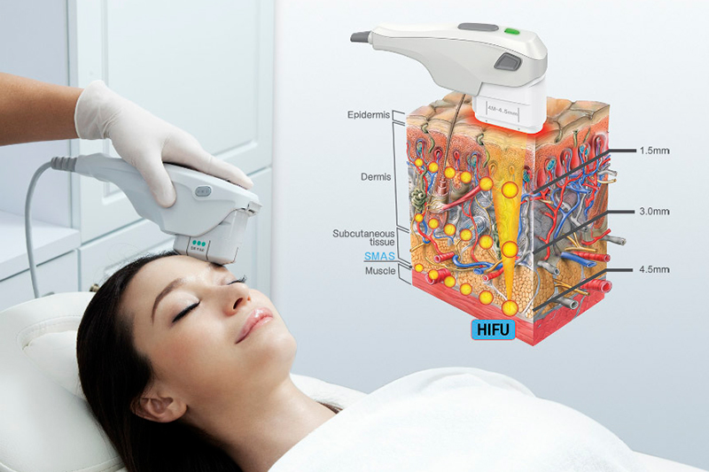 HIFU para rejuvenecimiento facial: aplicación y capas de la piel tratadas
