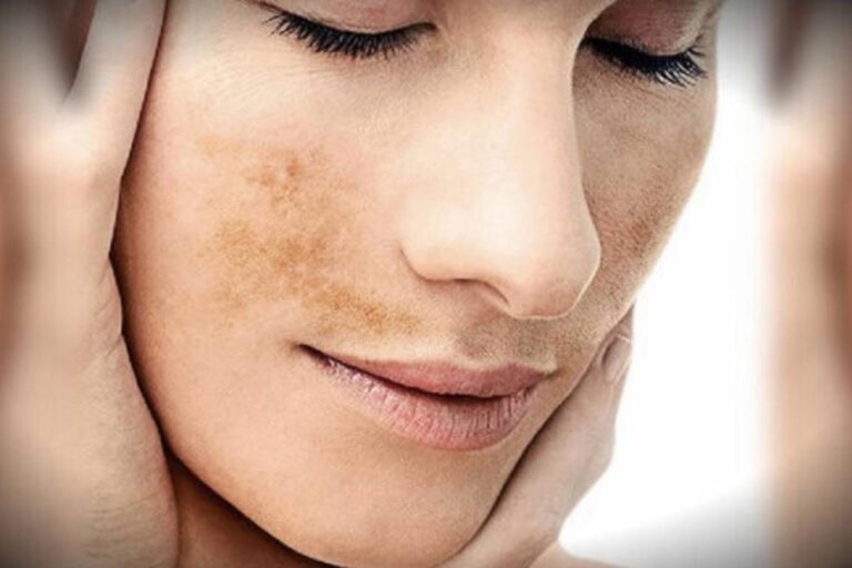 Melasma en la cara: manchas en la mejilla y el labio superior