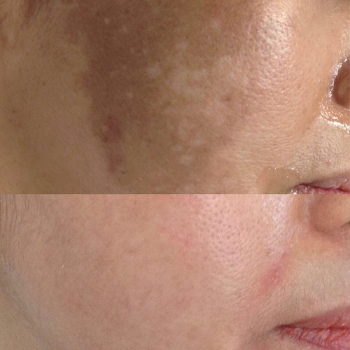 Tratamiento del melasma en la mejilla: antes y después